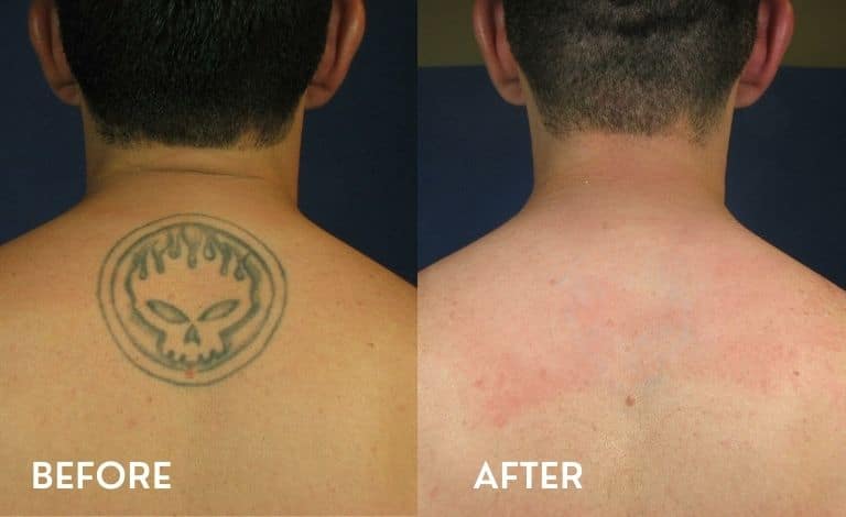 Why Is Tattoo Removal So Difficult? - inkology-UK