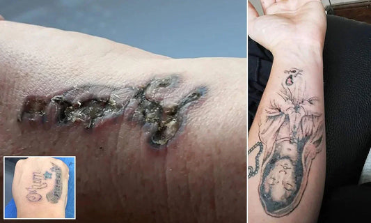 The Hidden Dangers of Laser Tattoo Removal - inkology-UK